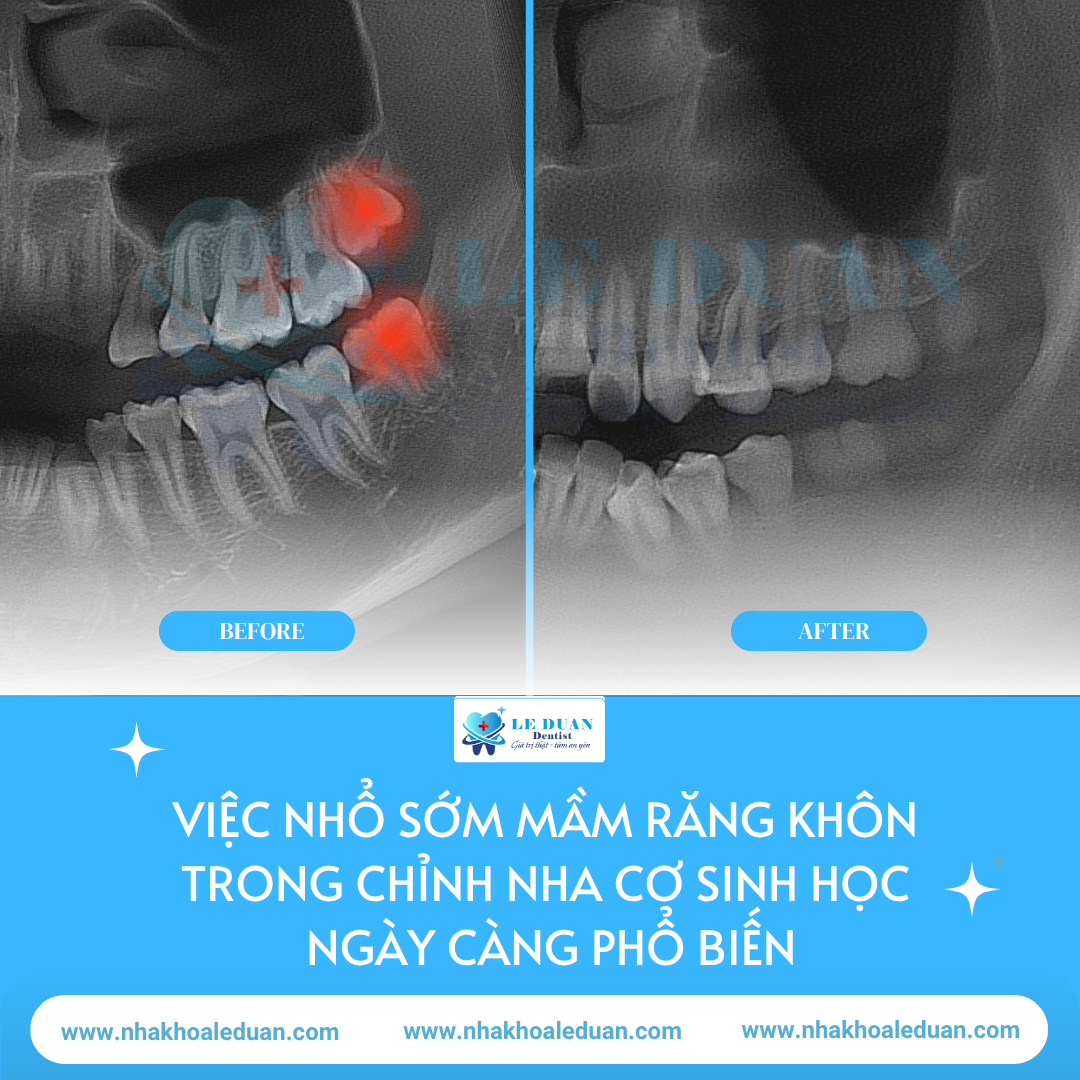 Vì sao bác sĩ chỉnh nha hiện đại đều khuyên NHỔ SỚM MẦM RĂNG KHÔN? Sự thật sẽ khiến bạn bất ngờ!